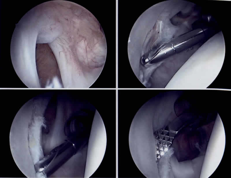 Bildserie einer arthroskopisch durchgeführten Schulterstabilisierung